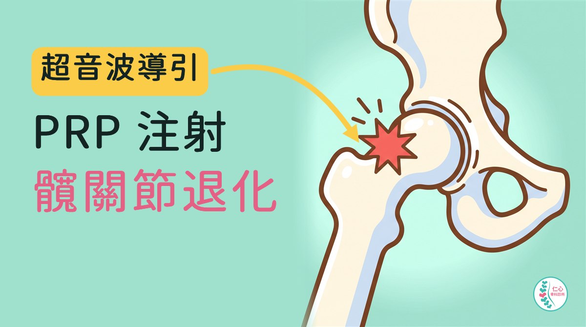 插畫：可愛的卡通髖關節骨頭，股骨頭與骨盆交界處有一個紅色痛點；左側大字「超音波導引　PRP 注射　髖關節退化」，黃色箭頭指向痛點，右下角是仁心骨科診所標誌。