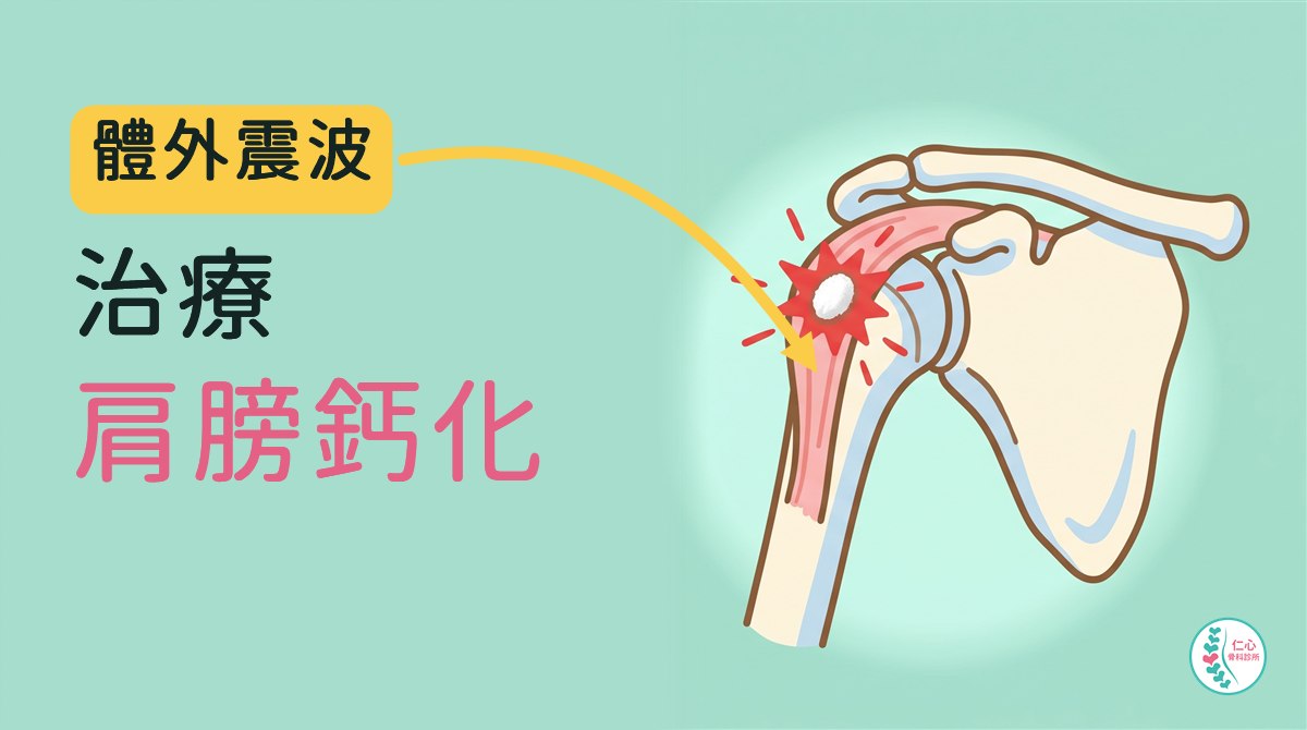 插畫：可愛的卡通肩關節骨頭，肩膀上方的肌腱裡有一顆白色鈣化點和紅色痛點；左側大字「體外震波　治療　肩膀鈣化」，黃色箭頭指向痛點，右下角是仁心骨科診所標誌。