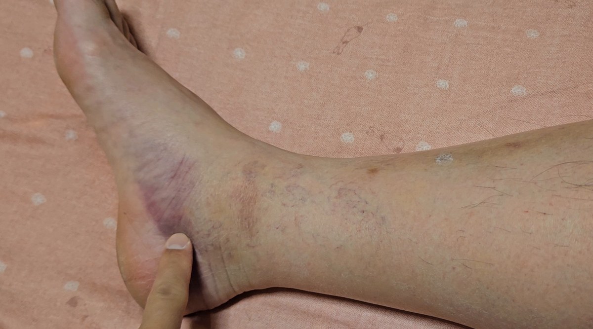 作者本人受傷第六天的右腳：腳踝內側與腳跟周圍一片紫色瘀青，手指指著瘀青的位置。