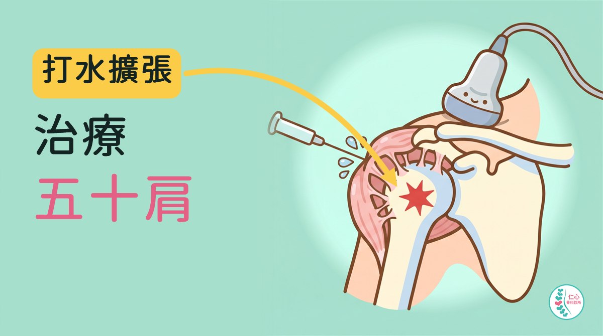 插畫：卡通肩關節，粉紅色的關節囊皺縮變厚，和骨頭之間黏著許多拉絲，中間有紅色痛點；超音波探頭放在肩上，針從側面打進關節囊、冒出水滴；左側大字「打水擴張　治療　五十肩」，黃色箭頭指向痛點，右下角是仁心骨科診所標誌。