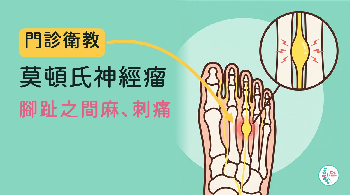 插畫：卡通腳骨俯視圖，腳趾朝上，第三、第四根蹠骨之間有一條黃色神經，前腳掌處腫成紡錘形並有紅色光暈；右上圓形放大框畫出兩根骨頭之間腫起來的神經與紅色閃電線，表示麻、刺痛。左側大字「門診衛教　莫頓氏神經瘤　腳趾之間麻、刺痛」，右下角是仁心骨科診所標誌。