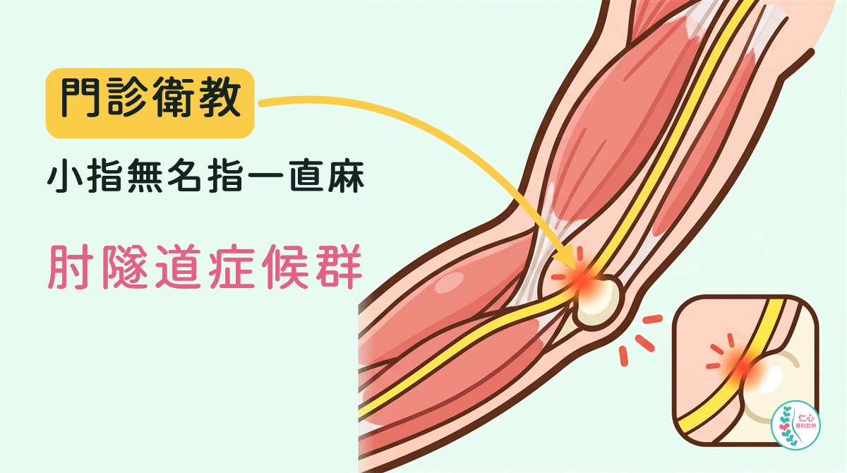 插畫：卡通手肘內側的肌肉，黃色的尺神經繞過手肘內側的骨頭突起處，被壓迫的地方發紅，右下角放大圖；左側大字「門診衛教　小指無名指一直麻　肘隧道症候群」，黃色箭頭指向壓迫處，右下角是仁心骨科診所標誌。
