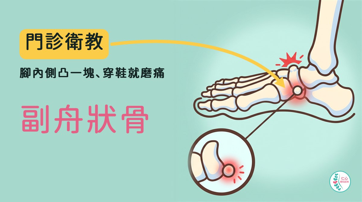 插畫：從腳內側看的卡通腳骨，舟狀骨旁邊多出一顆小骨頭（副舟狀骨），有紅色疼痛標記；下方圓形放大圖畫出這顆小骨頭與周圍淡紅色發炎；左側大字「門診衛教　腳內側凸一塊、穿鞋就磨痛　副舟狀骨」，黃色箭頭指向那顆小骨頭，右下角是仁心骨科診所標誌。