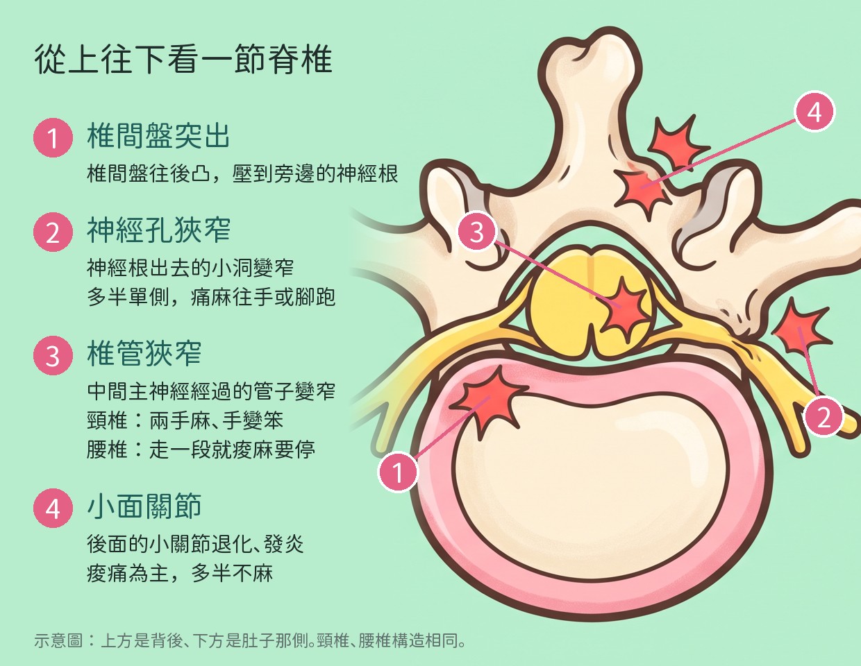 脊椎橫切面示意圖，從上往下看一節脊椎，標出四個位置：①椎間盤往後凸壓到神經根、②神經根出去的小洞變窄（神經孔狹窄）、③中間主神經經過的管子變窄（椎管狹窄）、④後面的小關節退化發炎（小面關節）。頸椎、腰椎構造相同。