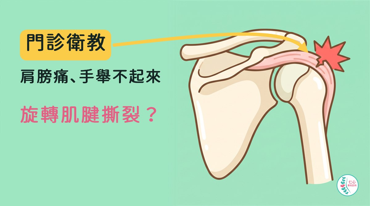 卡通插圖：右肩關節正面，肩胛骨、肩峰與肱骨頭，粉紅色旋轉肌腱從肩峰下方接到肱骨頭外上方，接點有一個小裂口與紅色星號