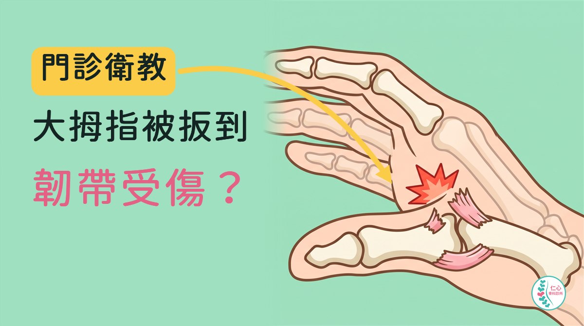 卡通插圖：手背朝上、大拇指往外扳開，大拇指掌指關節兩側各有一條粉紅色側韌帶，靠虎口那條斷開、旁邊紅色星號標示痛點，外側那條完整