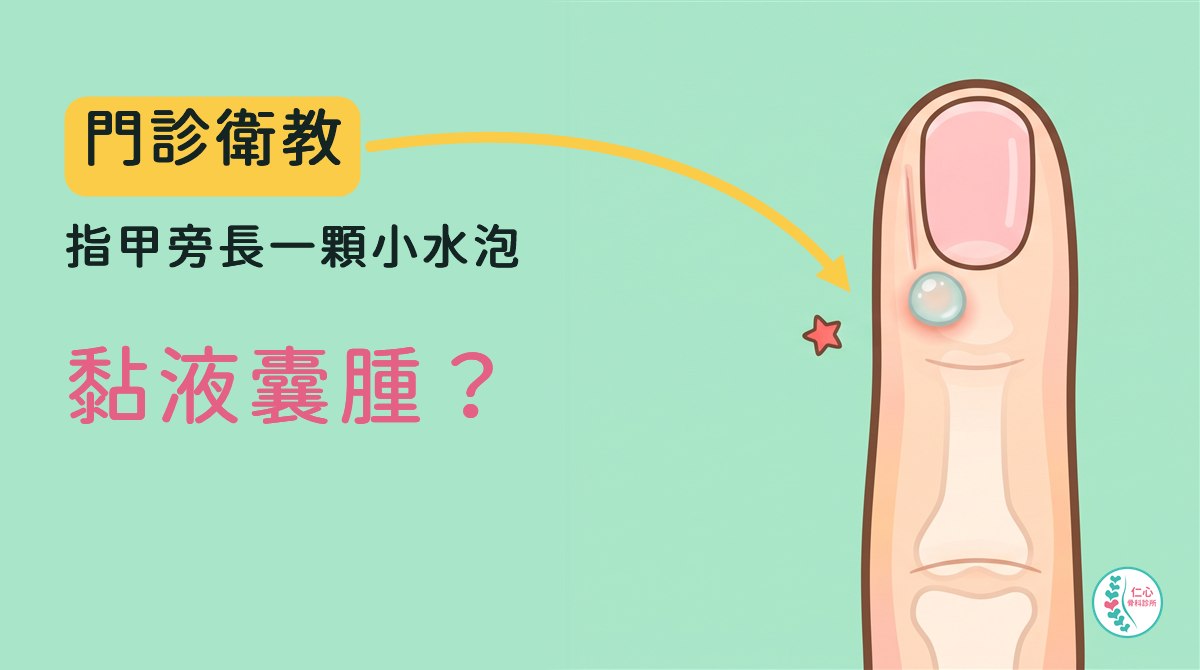插畫：從手背上方看的一根卡通手指，指甲根部下方、偏一側的皮膚鼓起一顆透亮的小水泡，指甲上有一條淡淡的直溝，皮膚下隱約看得到米白色指骨，旁邊一顆小紅星；左側大字「門診衛教　指甲旁長一顆小水泡　黏液囊腫？」，黃色箭頭指向水泡，右下角是仁心骨科診所標誌。