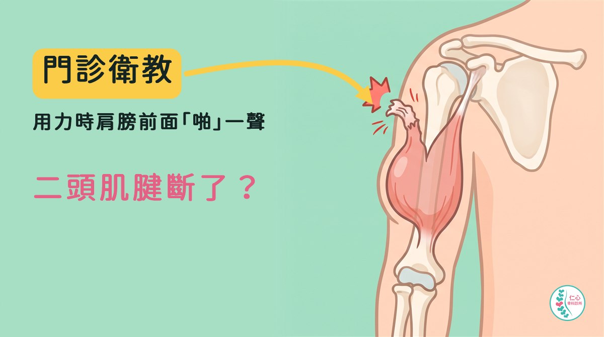 插畫：卡通右肩與上臂，米白色骨頭，肱二頭肌長頭肌腱在肩膀前面斷開捲起、旁邊有紅色爆炸星，肌肉往下縮在上臂中段鼓成一球；左側大字「門診衛教　用力時肩膀前面「啪」一聲　二頭肌腱斷了？」，黃色箭頭指向斷開處，右下角是仁心骨科診所標誌。