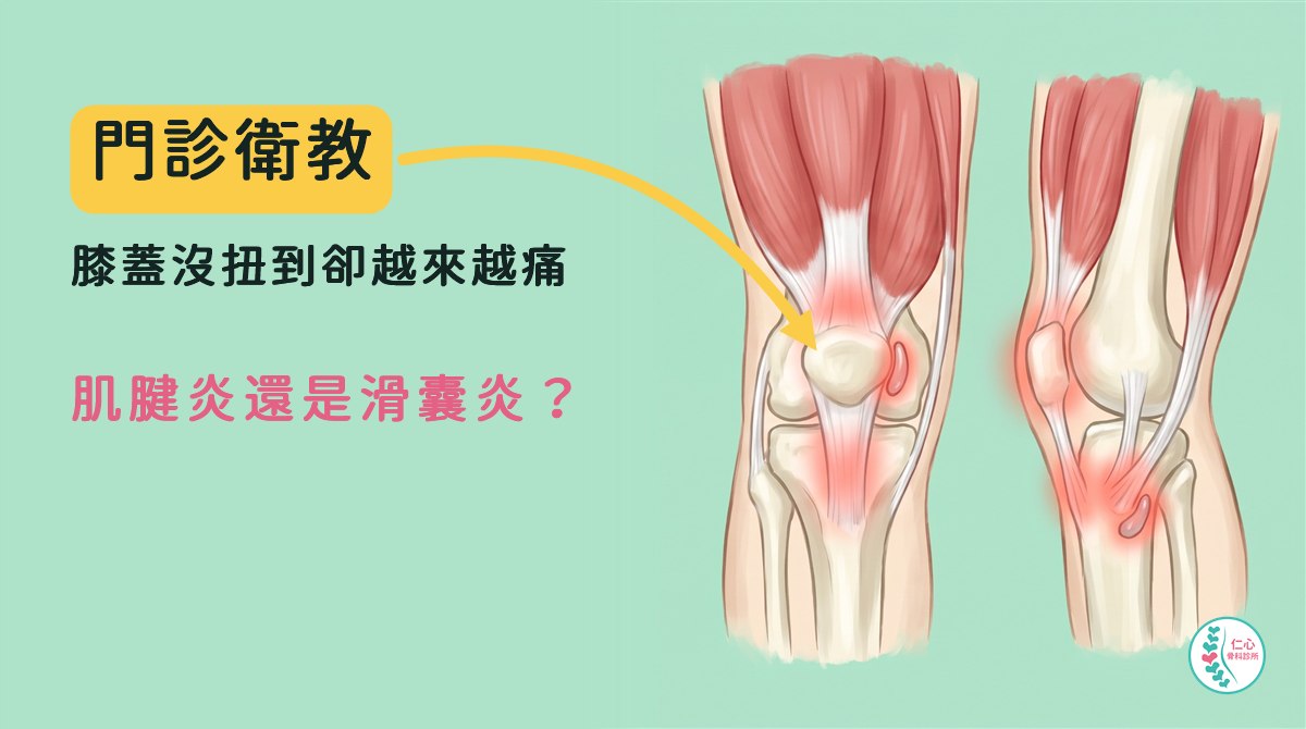 卡通插畫：右膝正面，膝蓋骨下方與上方的肌腱、膝蓋內側下方的細肌腱微微紅腫，膝蓋骨前方的滑囊微微腫起。