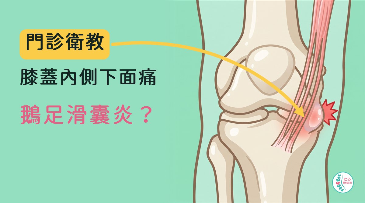 卡通插畫：右膝正面，膝蓋內側下方三條肌腱併在一起接到小腿骨上端，肌腱底下的滑囊微微腫起、紅紅的。